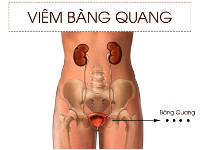 Tìm hiểu nguyên nhân gây ra bệnh viêm bàng quang và cách điều trị bệnh