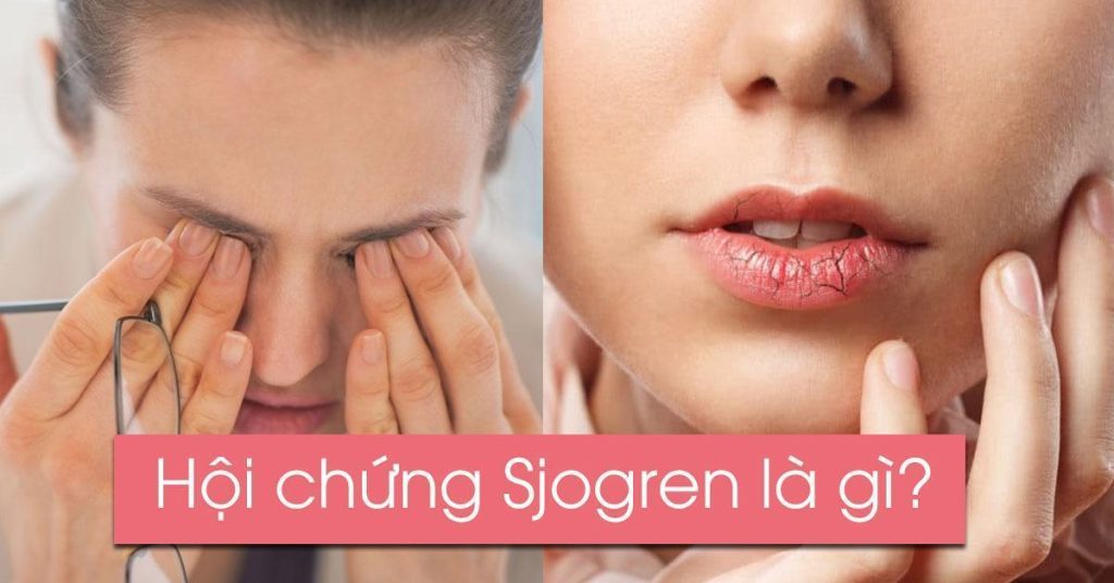 Tìm hiểu nguyên nhân và cách điều trị của hội chứng Sjogren