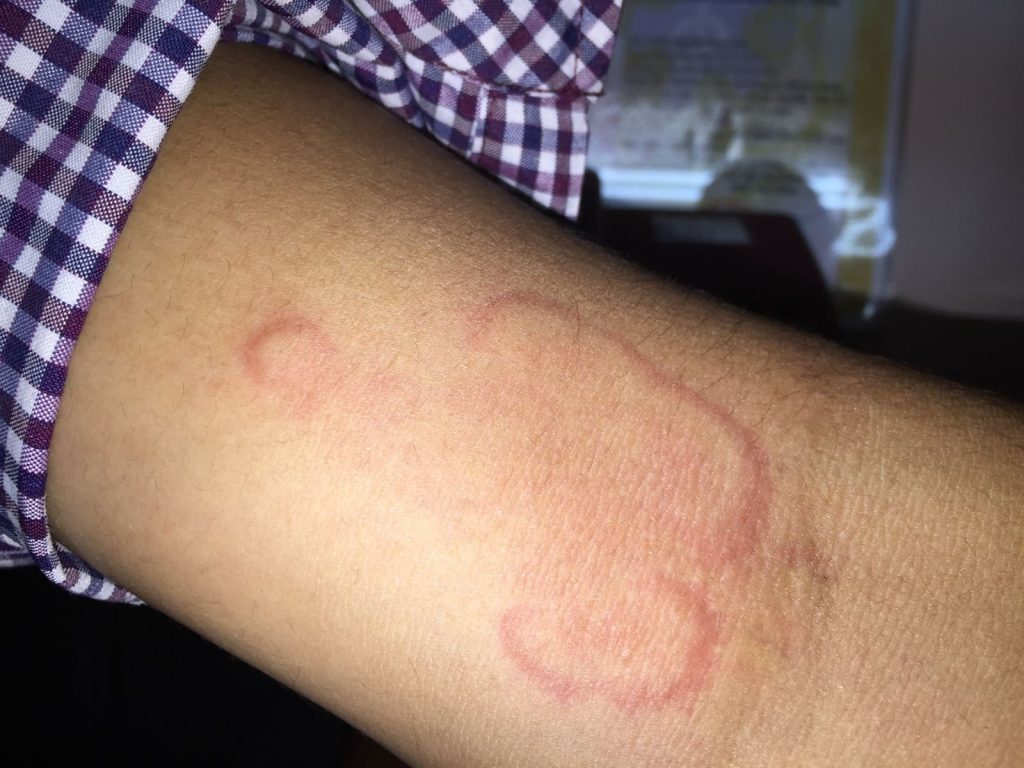 Tìm hiểu về giun chỉ, cách điều trị và phòng ngừa bệnh