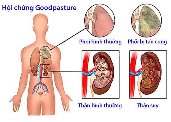 Tìm hiểu về hội chứng Goodpasture