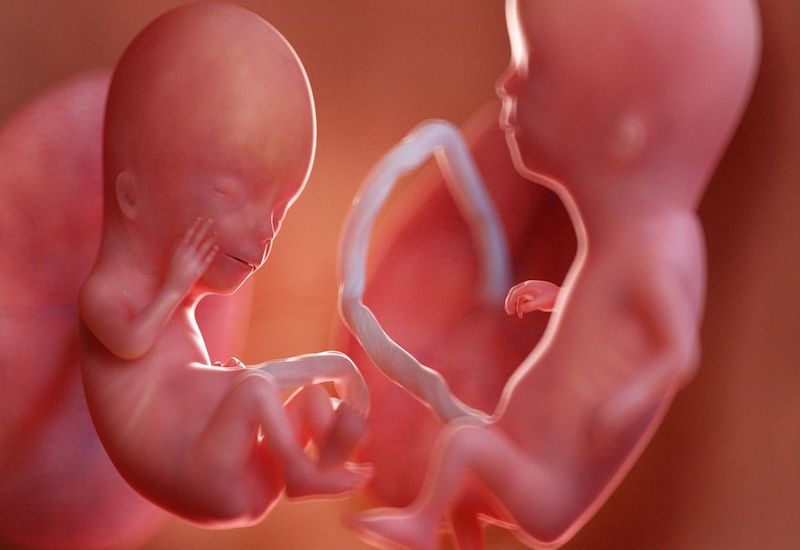 Tổng quan hội chứng truyền máu song thai nguy hiểm