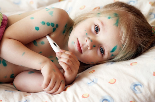 Thủy đậu có thể tự khỏi nếu biết cách nghỉ ngơi và ăn uống