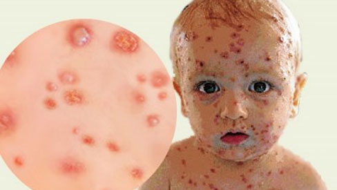 Triệu chứng và cách điều trị hiệu quả bệnh thủy đậu
