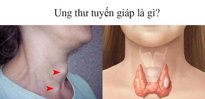Những triệu chứng ung thư tuyến gi&aacute;p 