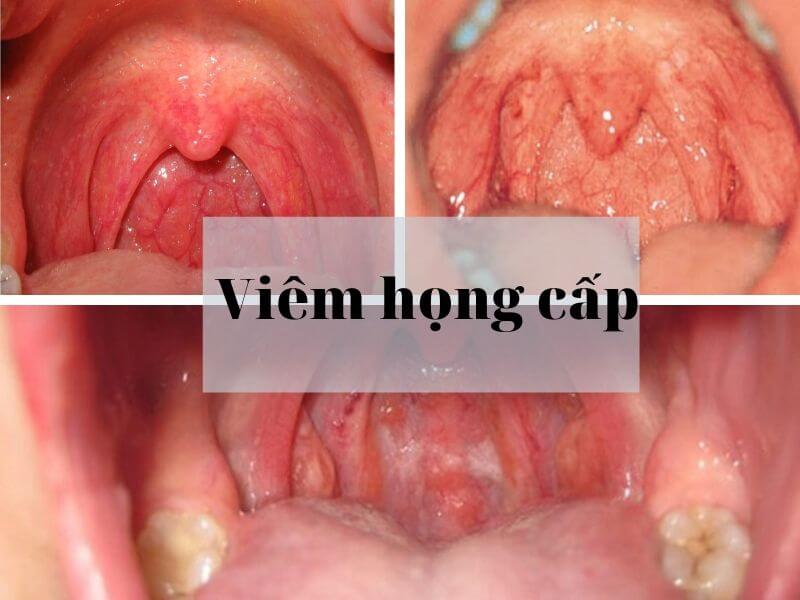 Viêm họng cấp là gì? Cách chữa trị đau họng tại nhà an toàn