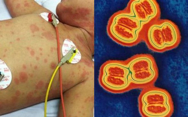 viem-mang-nao-do-mo-cau