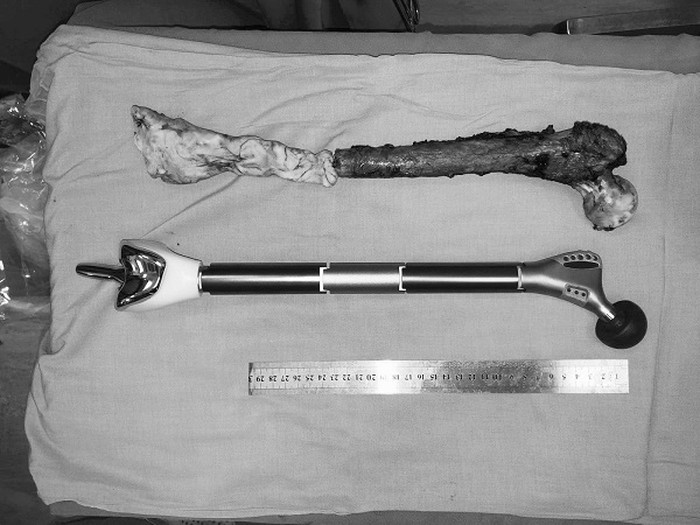 Xương đ&ugrave;i bằng kim loại được đo đạc cẩn thận dưới định dạng 3D