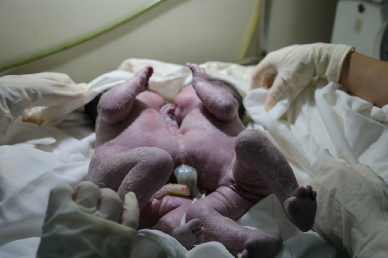 Hai b&eacute; g&aacute;i d&iacute;nh nhau phần gan đang được t&iacute;ch cực chăm s&oacute;c tại Bệnh viện Nhi đồng 1