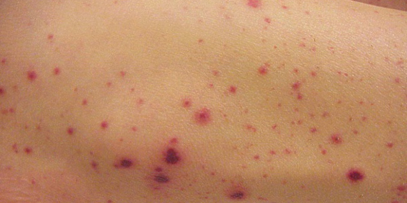 xuat-huyet-giam-tieu-cau