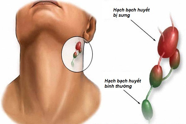 Sưng hạch bạch huyết ở cằm, cổ và cách chữa trị