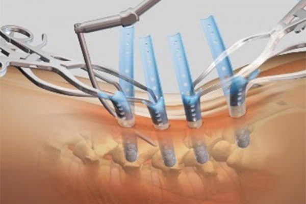 Thời gian rút dụng cụ nẹp xương là bao nhiêu?