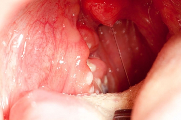 Các cách chữa viêm amidan hốc mủ hiệu quả